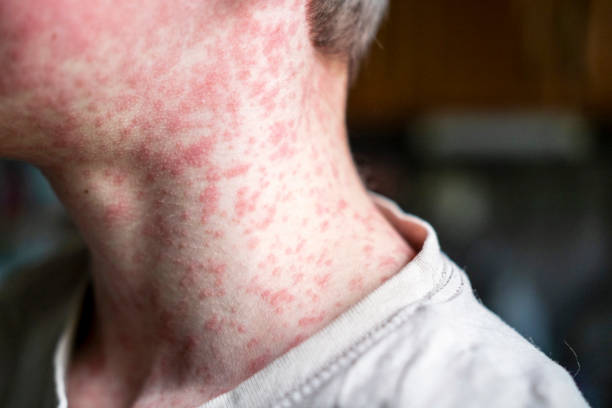 Épidémie de rougeole : 10 points essentiels que les Sud-Africains doivent savoir maintenant