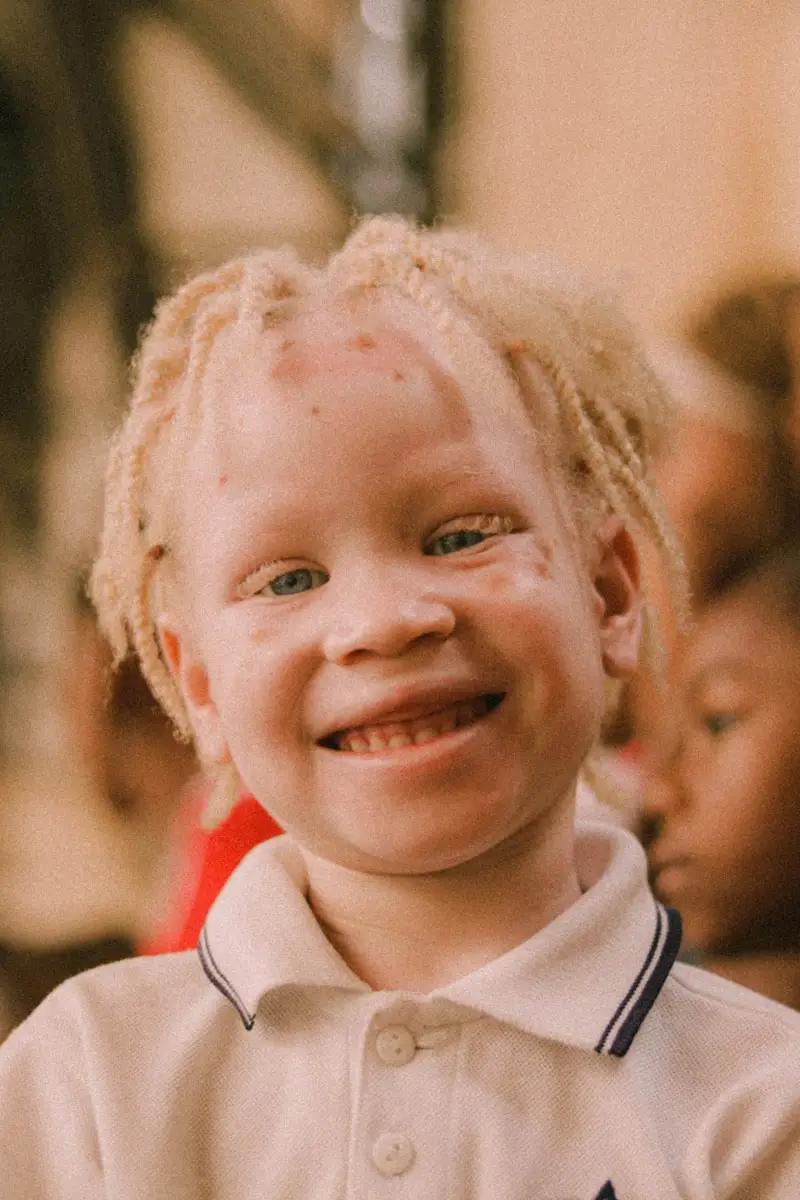 Albinism Beauty 2025 : de nouveaux standards qui inspirent