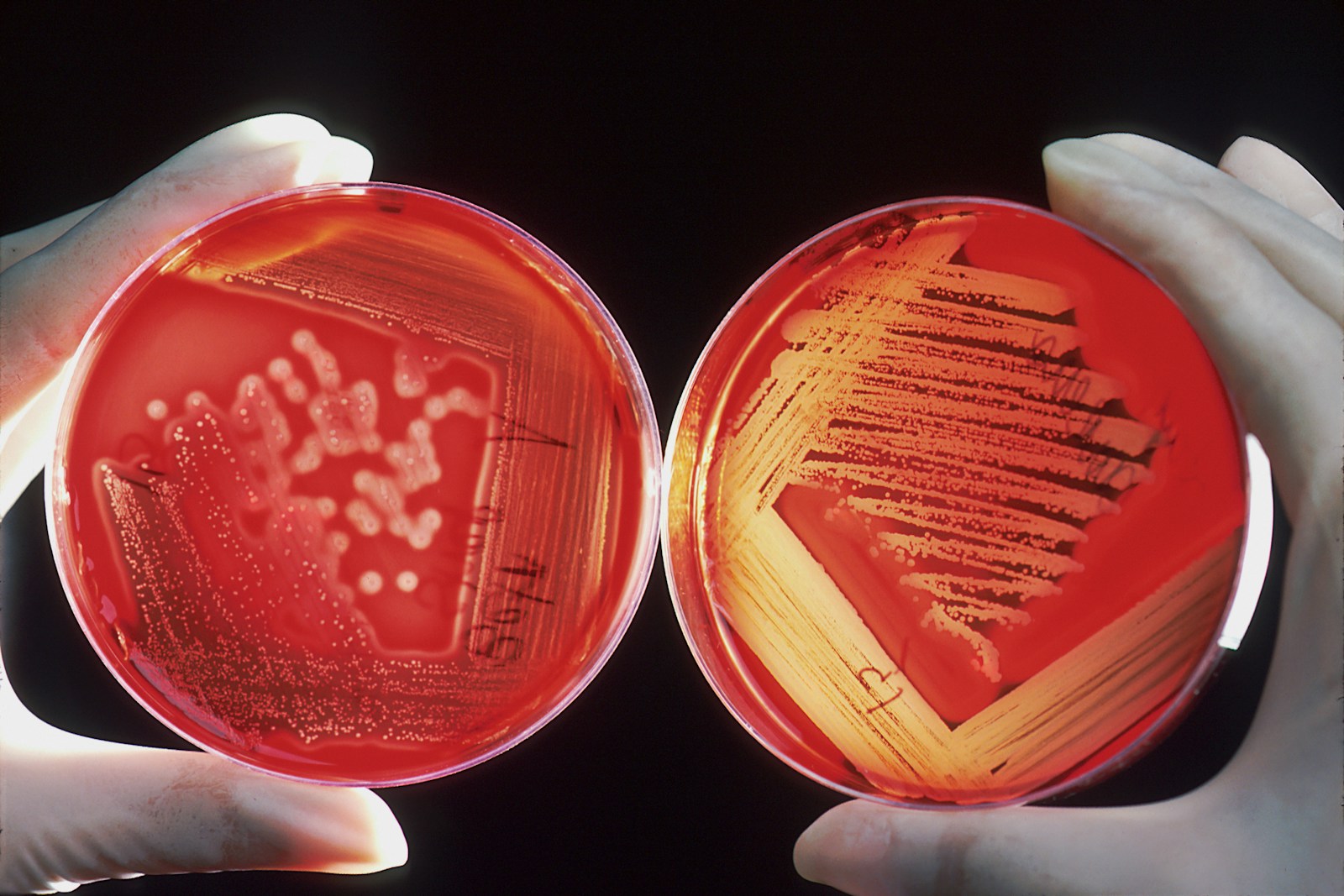 Mpox Case: First Monkeypox Infection Detected in Dakar