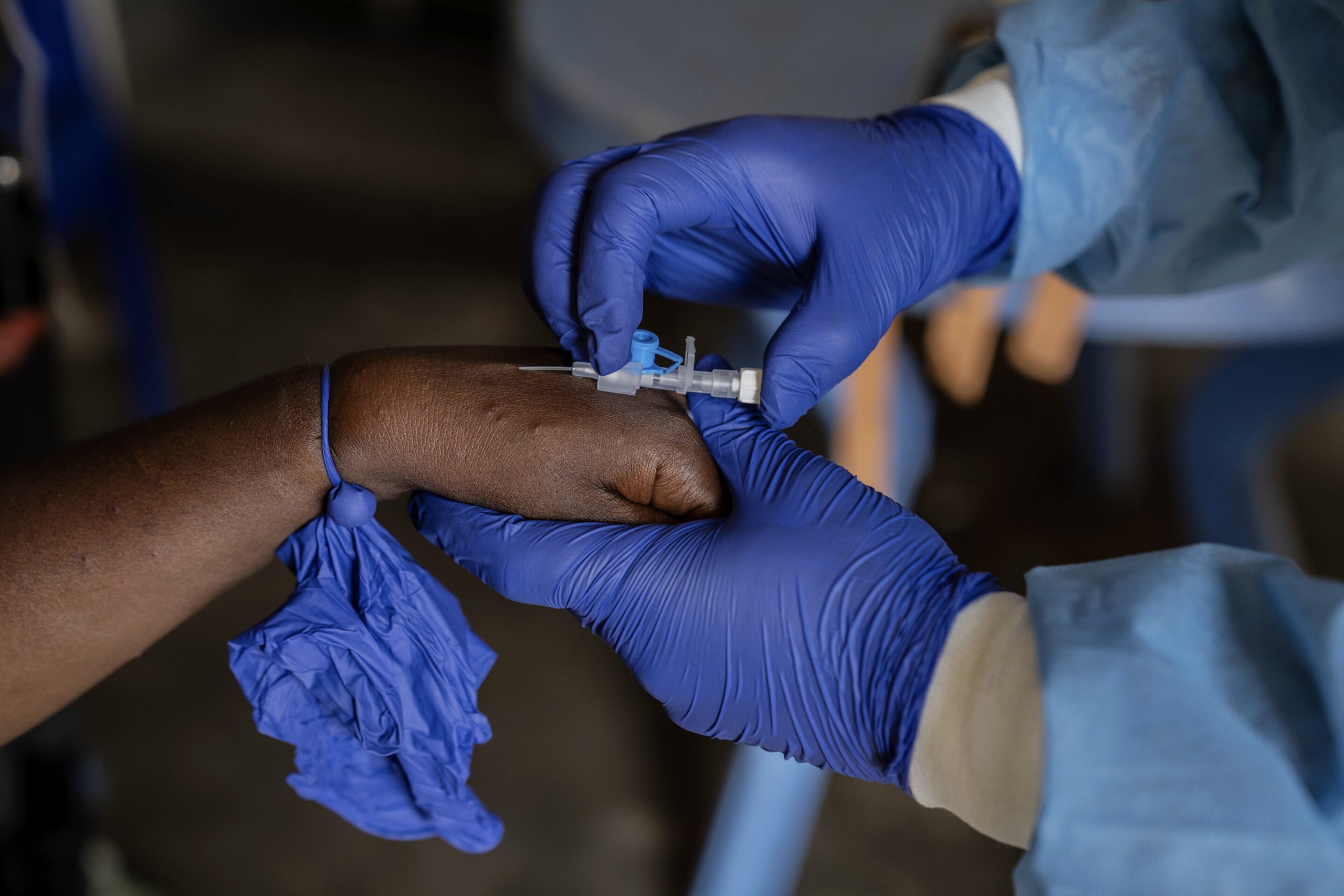 Mpox Cases in Africa Explode: Alarming New Data
