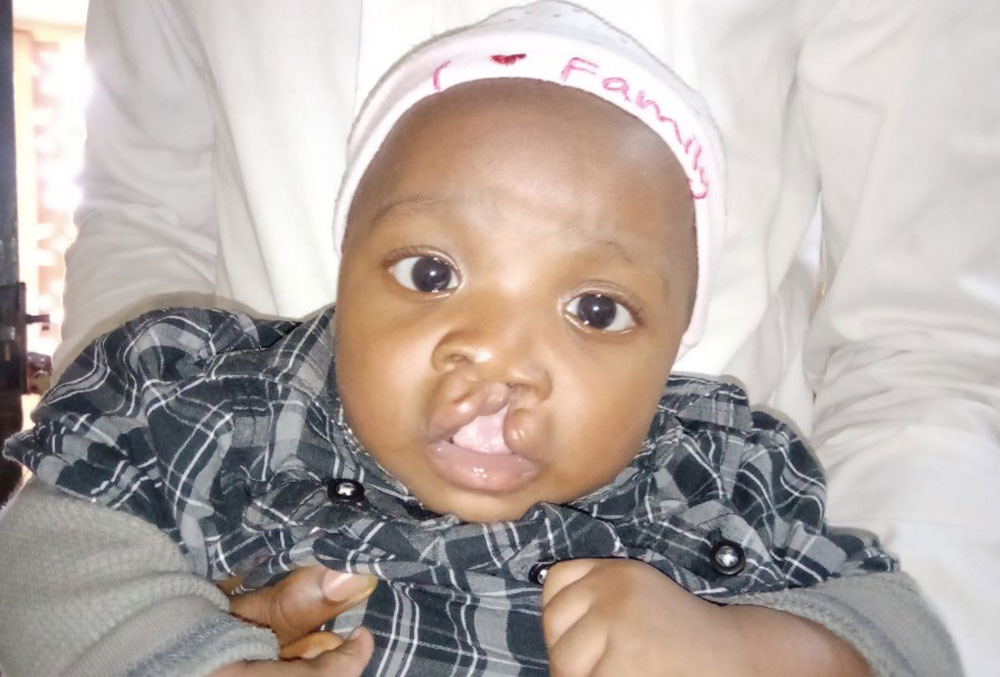 Cleft Lip Nigeria: 5 Shocking Myths Behind Child Sacrifice Rituals